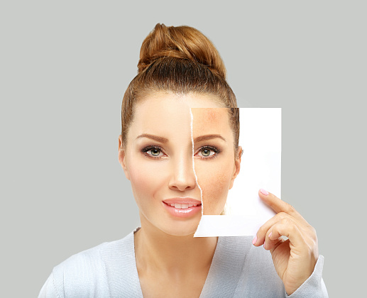 Удаление пигментных пятен и сосудов на аппарате Candela Vbeam